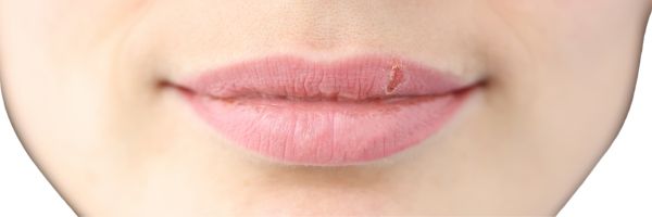 Cold sore on lips